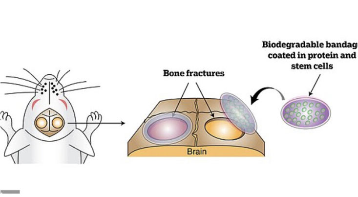 ابداع بانداژی برای درمان شکستگی